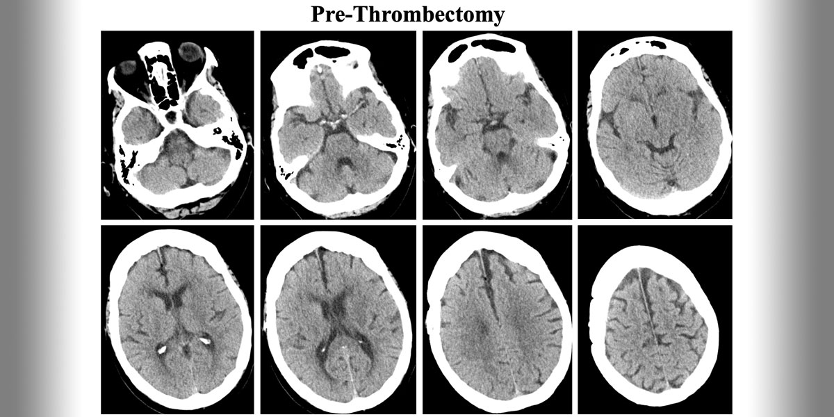 Pre-Thrombectomy